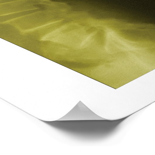 Spinal Degeneration Lumbar Spine Chiropractic Poster (Ecke)