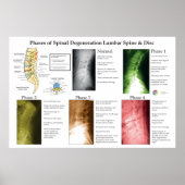Spinal Degeneration Lumbar Spine Chiropractic Poster (Vorne)