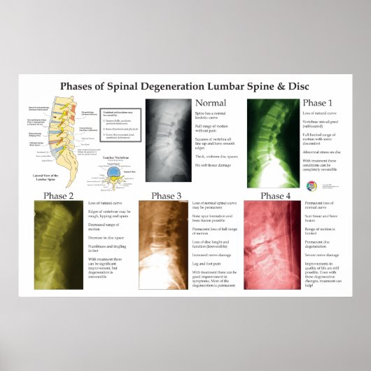 Spinal Degeneration Lumbar Spine Chiropractic Poster (Vorne)