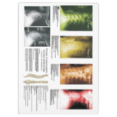 Spinale Degeneration Chiropraktische Zwischenablag Klemmbrett (Rückseite)