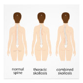 Spinalfehler Fotodruck (Vorne)