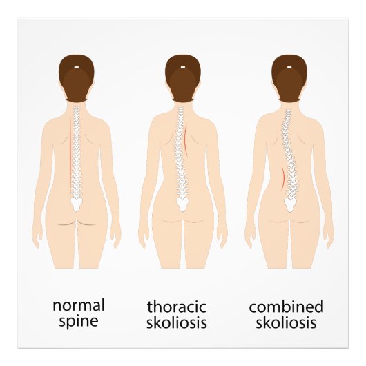 Spinalfehler Fotodruck (Vorne)