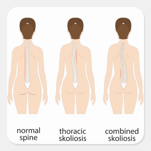 Spinalfehler Quadratischer Aufkleber (Vorderseite)