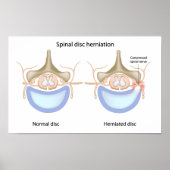 Spinalscheibenvorfall Poster (Vorne)