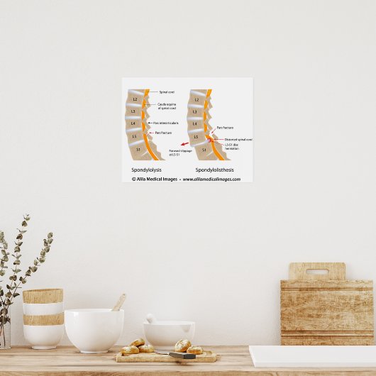 Spondylolyse und Spondylolisthese, gekennzeichnet Poster (Küche)