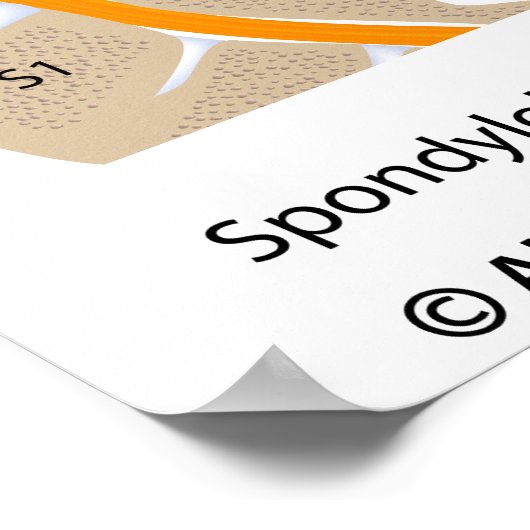 Spondylolyse und Spondylolisthese, gekennzeichnet Poster (Ecke)