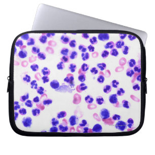 Staphyloinfektion Laptopschutzhülle