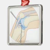 Steifes Endoskopie-Verfahren Silbernes Ornament (Links)