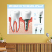 Struktur des Zahnimplantats Leinwanddruck (Insitu (Wohnzimmer))