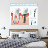 Struktur des Zahnimplantats Leinwanddruck (Insitu (Schlafzimmer))