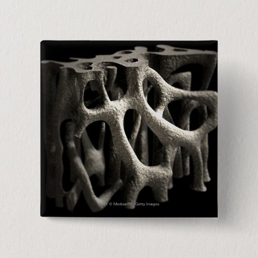 Struktur eines Knochens mit Osteoporose Button (Vorderseite)