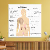 Symptome Fibromyalgie Canvas Print Leinwanddruck (Insitu (Wohnzimmer))