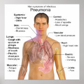 Tabelle der Symptome einer Pneumonie Poster (Vorne)