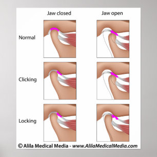 Temporomandibuläre Gelenkfunktionsstörungen, TMJ o Poster