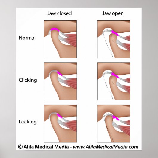 Temporomandibuläre Gelenkfunktionsstörungen, TMJ o Poster (Vorne)