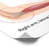 Tennis Ellenbogen Sport Poster (Ecke)