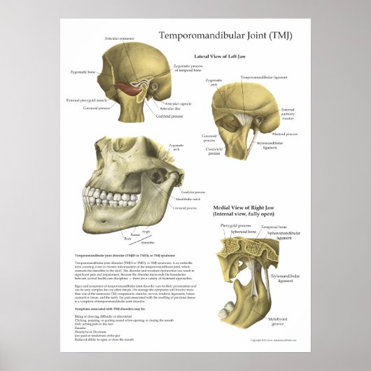 TMJ Joint Syndrome Anatomy Medical Poster (Vorne)