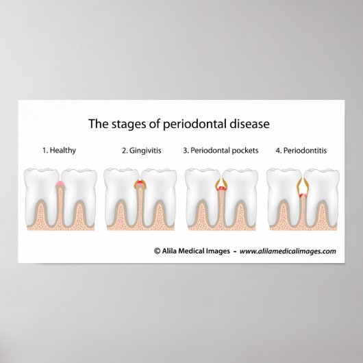 Tooth Periodontal Disease Poster (Vorne)