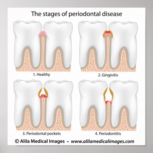 Tooth Periodontal Disease Poster (Vorne)