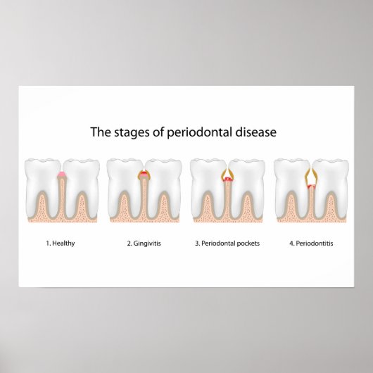Tooth Periodontal Disease Poster (Vorne)