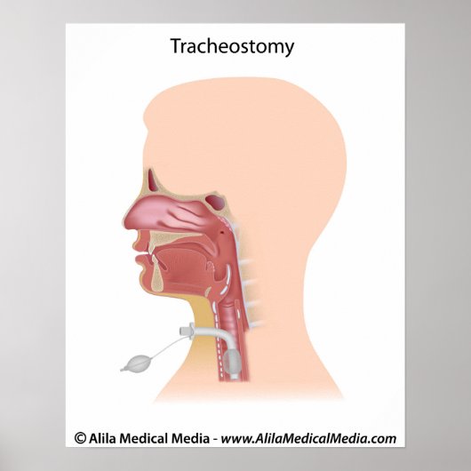 Tracheostomie zeichnend. poster (Vorne)