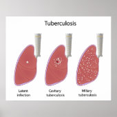 Tuberkulose Poster (Vorne)