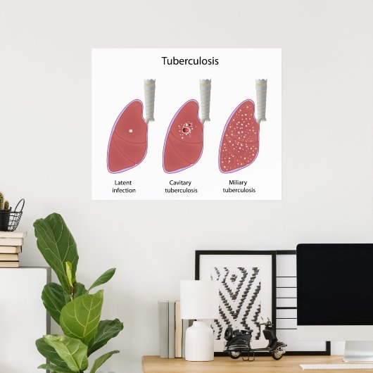 Tuberkulose Poster (Heimbüro)