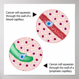 Tumorzellmetastase Poster
