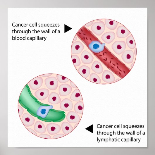 Tumorzellmetastase Poster (Vorne)