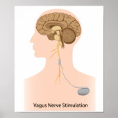 Vagus Nervenstimulation Poster (Vorne)
