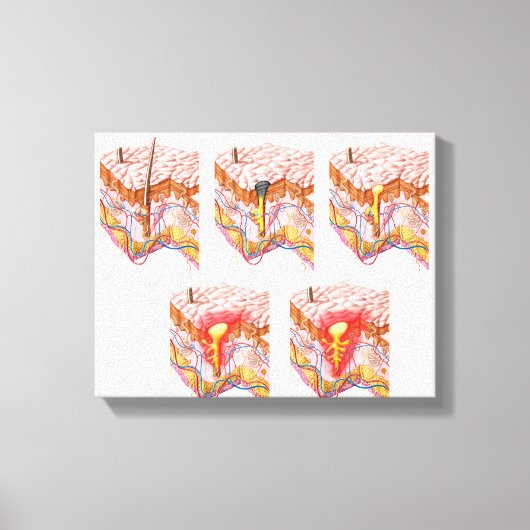 Verschiedene Arten von Akne Leinwanddruck (Vorderseite)