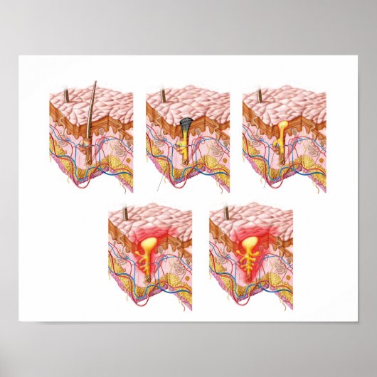 Verschiedene Arten von Akne Poster (Vorne)