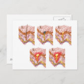 Verschiedene Arten von Akne Postkarte (Vorne/Hinten)