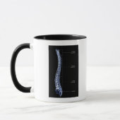 Vertebrale Spalte 4 Tasse (Links)