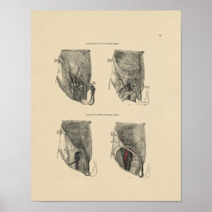 Vintage-Hernien-Anatomie 1880 Druck Poster