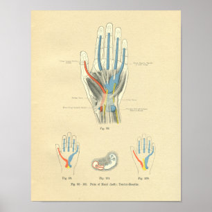 Vintage Morbus Frohse Anatomie von Hand und Tendon Poster