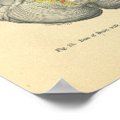 Vintager Frohse Anatomische Hirnhautentzündungen Poster (Ecke)