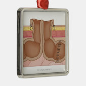 Vorübergehender Colostomy Silbernes Ornament (Rechts)