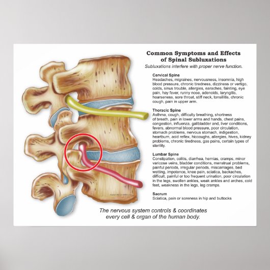 Wirkungen der Spinalsubluxation Chiropraktisches P Poster (Vorne)