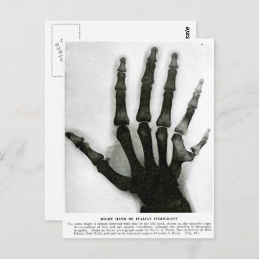 X-Ray Hand mit Extra Finger Postkarte (Vorne/Hinten)