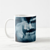 Zähne Röntgenaufnahme Kaffeetasse (Links)