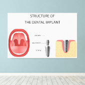Zahnimplantatstruktur Leinwanddruck (Insitu (Holzboden))