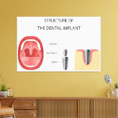 Zahnimplantatstruktur Leinwanddruck (Insitu (Wohnzimmer))