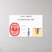 Zahnimplantatstruktur Leinwanddruck (Vorderseite)