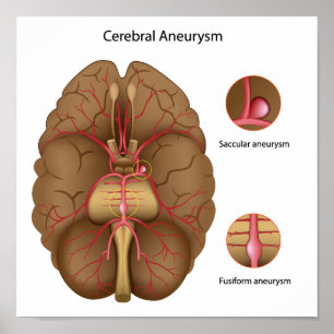 Zerebrale Aneurysma Poster