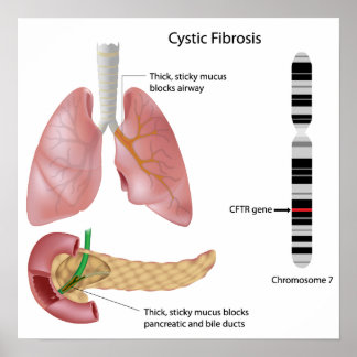 Zystische Fibrose Poster