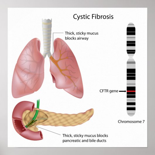 Zystische Fibrose Poster (Vorne)